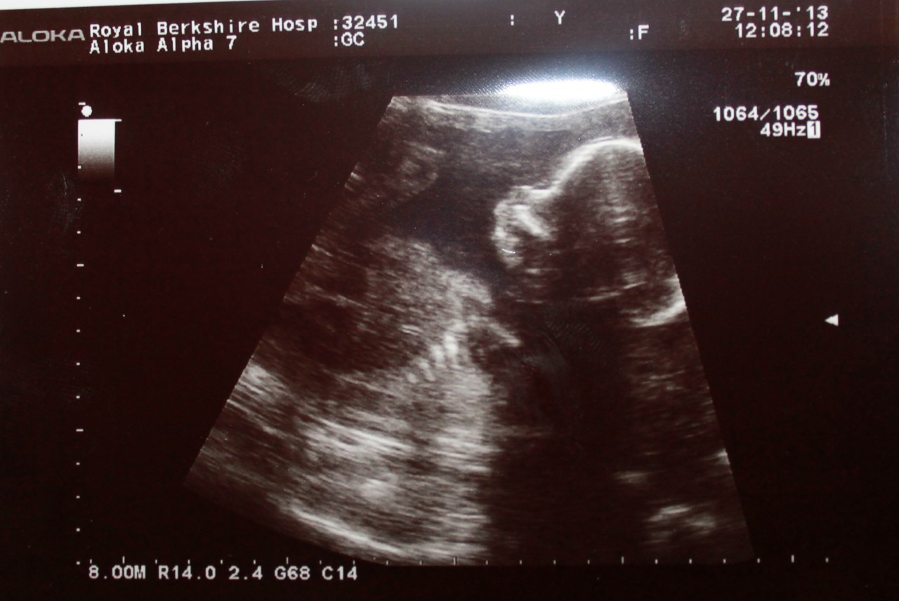 Introducing my Little Madam jpg 20 Week Anomaly Scan: The Gender Reveal