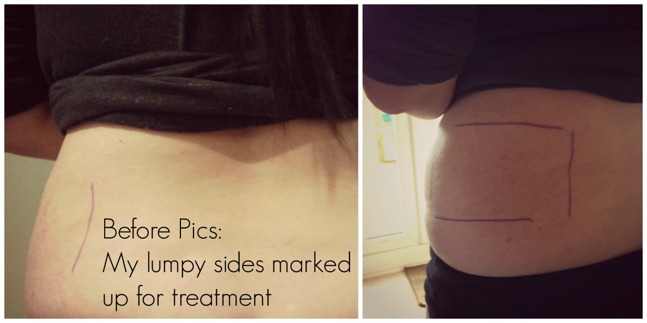 Before Flanks My Sculptlite Fat Freezing Treatment