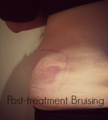 Lipoglaze Bruise My Sculptlite Fat Freezing Treatment