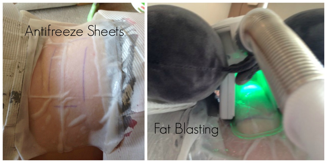 Lipoglaze Treatment My Sculptlite Fat Freezing Treatment