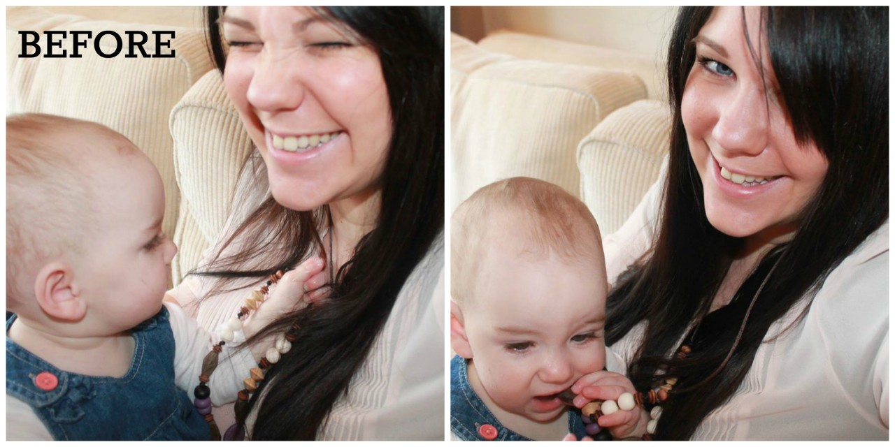 BeforeTeethWhitening